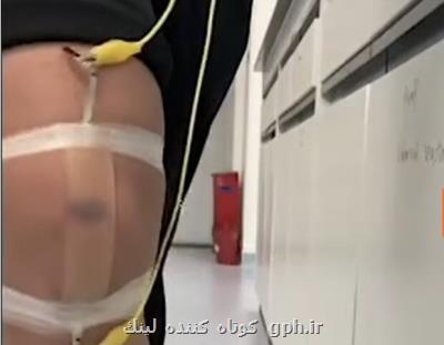 پوست مصنوعی كه در اثر ضربه كبود می شود!