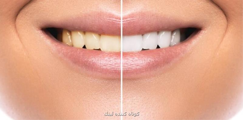 تاثیر مخرب محصولات سفید کننده بر دندان ها