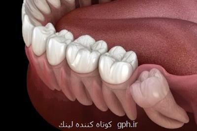 ساخت دستگاهی کاربردی در ترمیم ریشه دندان توسط فناوران ایرانی