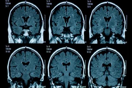 پیری زودرس مغز نوجوانان به دنبال قرنطینه کووید-19