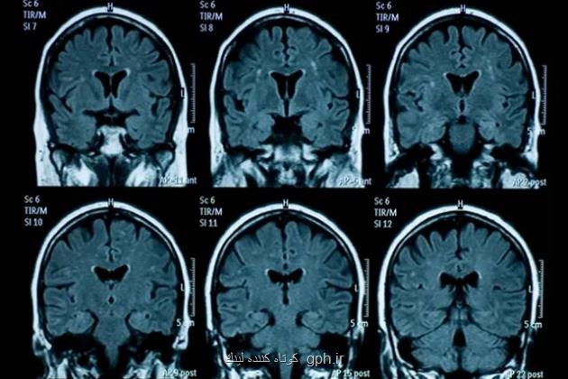 پیری زودرس مغز نوجوانان به دنبال قرنطینه کووید-19