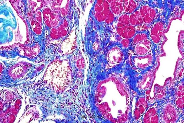 کشف پروتئین قاتلی که موجب سرطان لوزالمعده می شود