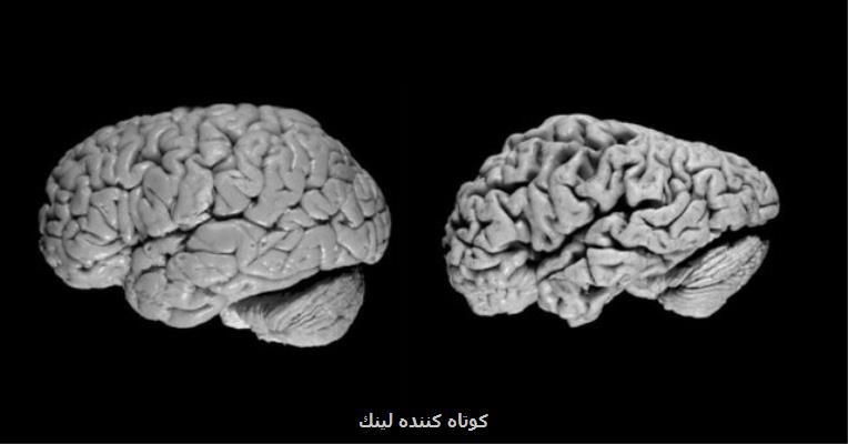 واكسنی كه پیشرفت آلزایمر را كند می كند